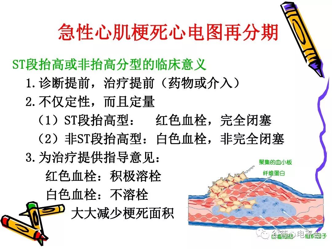 急性心肌梗死新定义（全球统一定义）