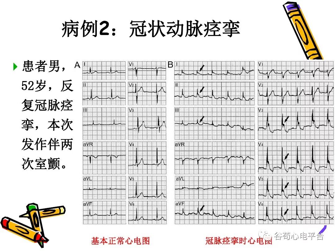 急性心肌梗死新定义（全球统一定义）