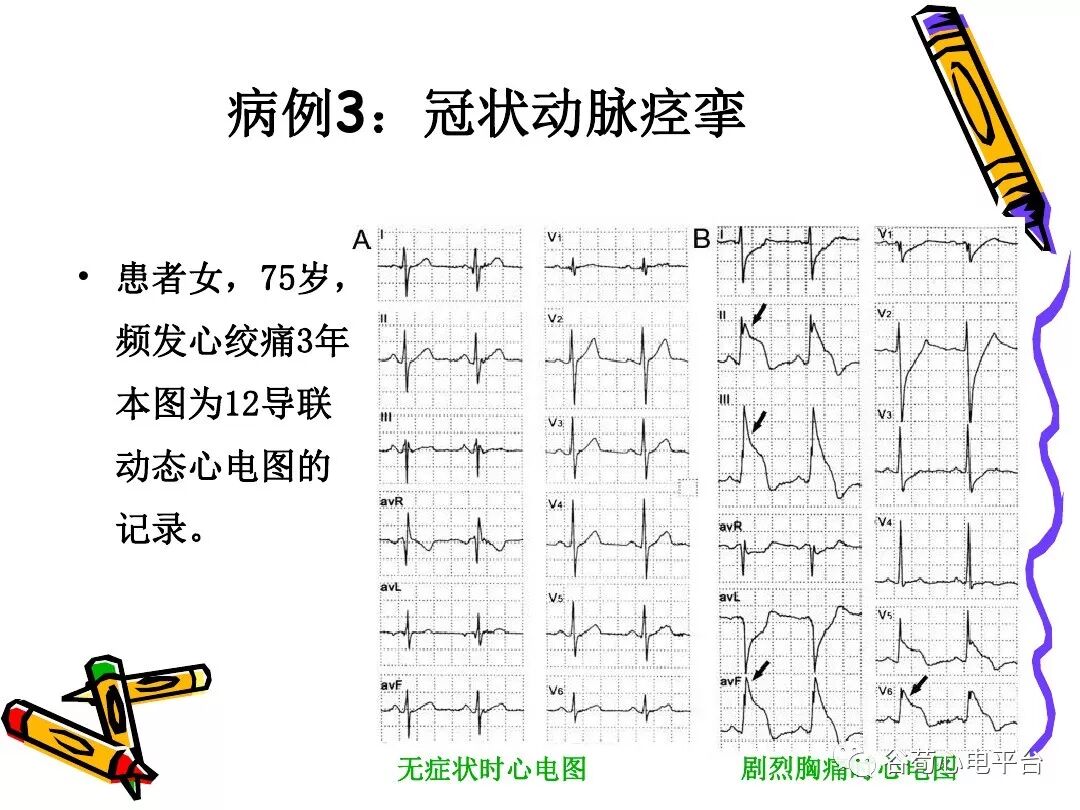急性心肌梗死新定义（全球统一定义）