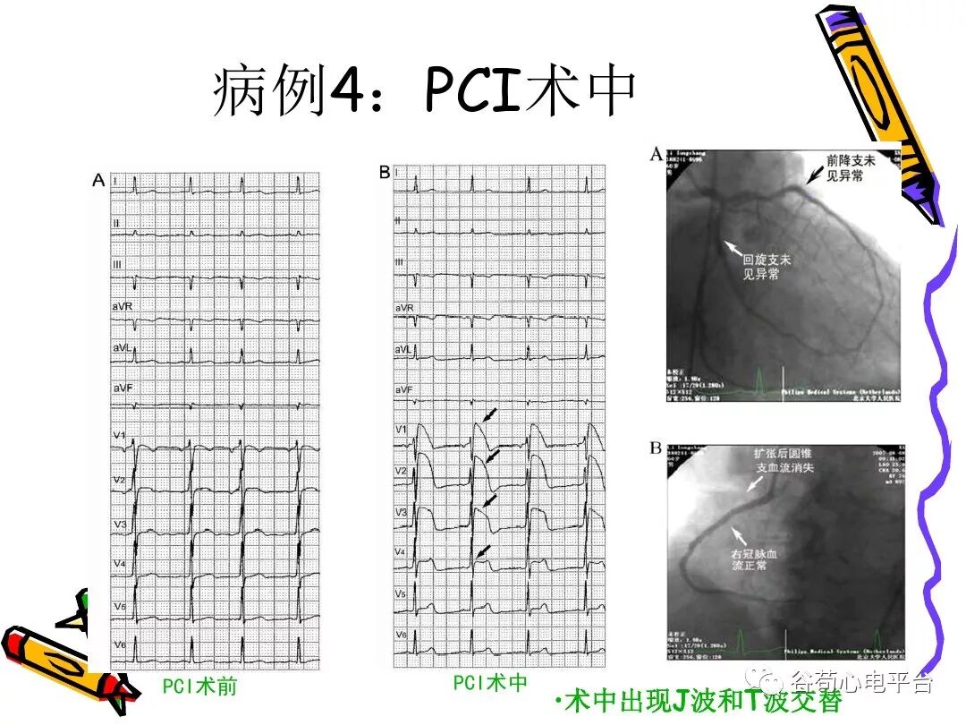 急性心肌梗死新定义（全球统一定义）