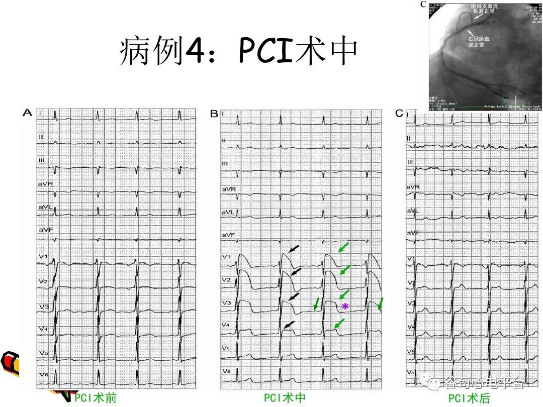 急性心肌梗死新定义（全球统一定义）