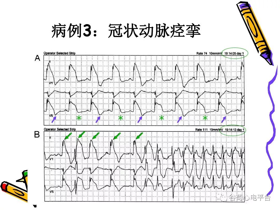 急性心肌梗死新定义（全球统一定义）