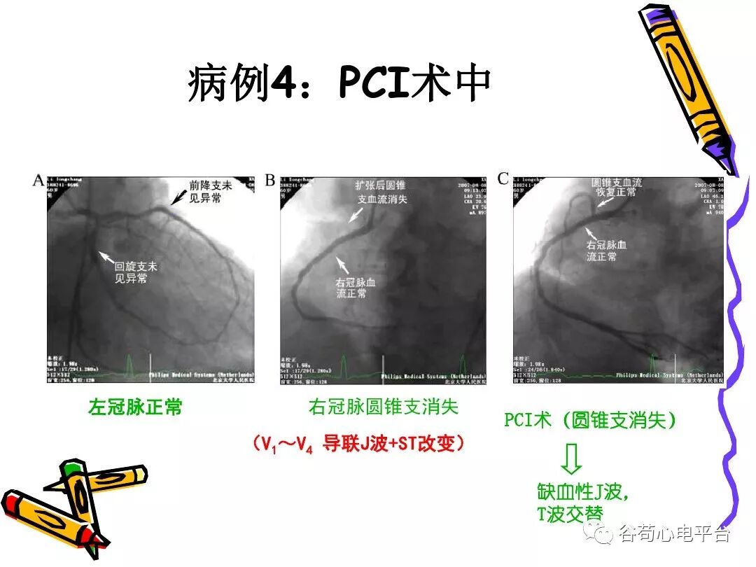 急性心肌梗死新定义（全球统一定义）