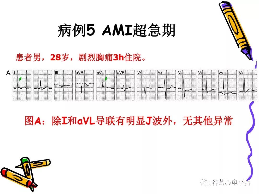 急性心肌梗死新定义（全球统一定义）