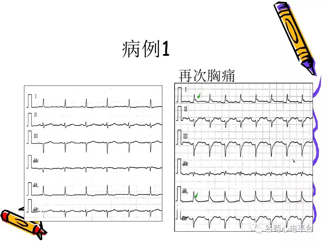 急性心肌梗死新定义（全球统一定义）