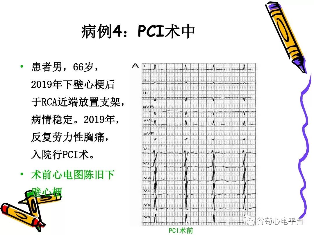 急性心肌梗死新定义（全球统一定义）