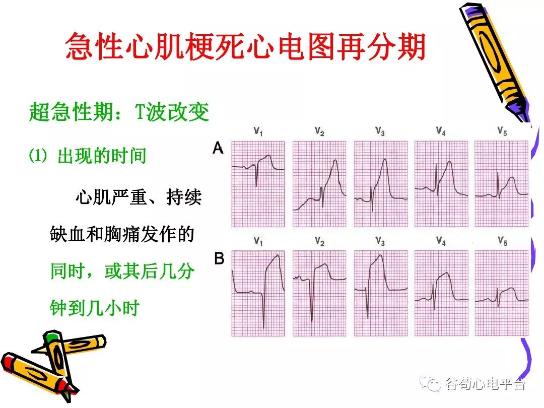 急性心肌梗死新定义（全球统一定义）