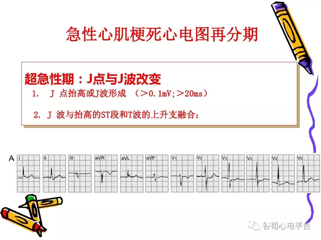 急性心肌梗死新定义（全球统一定义）