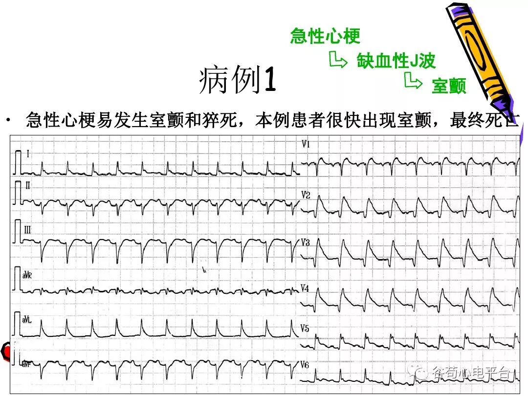 急性心肌梗死新定义（全球统一定义）