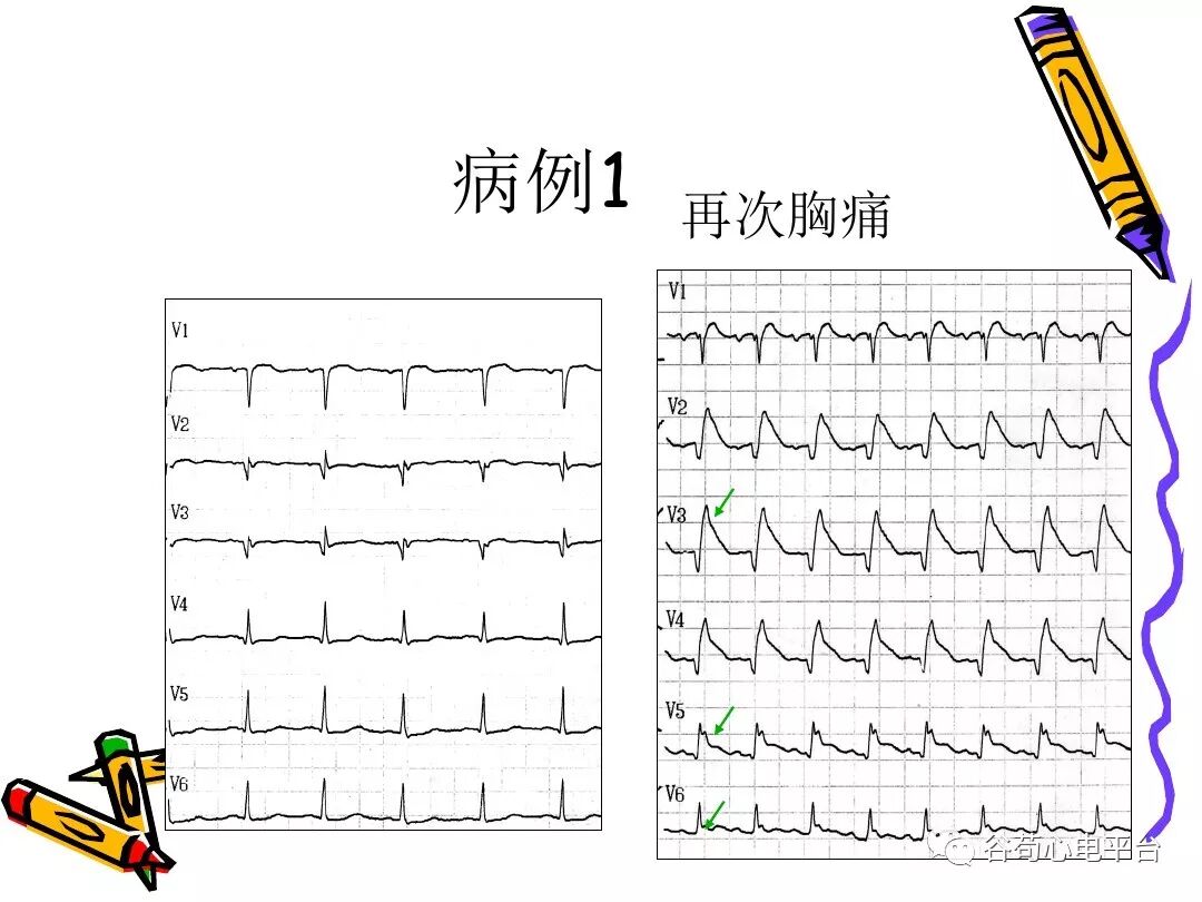 急性心肌梗死新定义（全球统一定义）