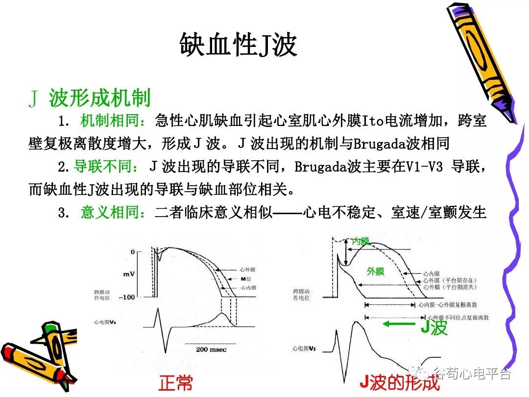 急性心肌梗死新定义（全球统一定义）