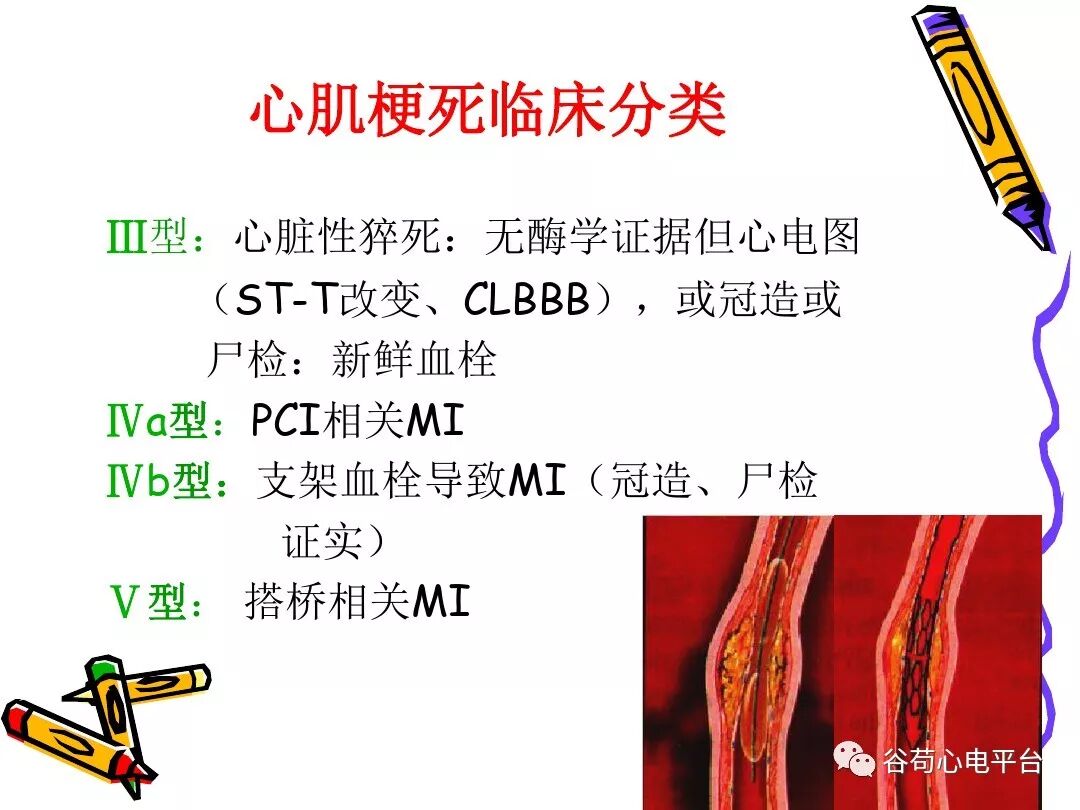 急性心肌梗死新定义（全球统一定义）