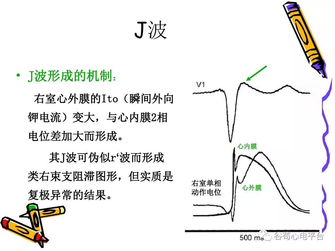 急性心肌梗死新定义（全球统一定义）