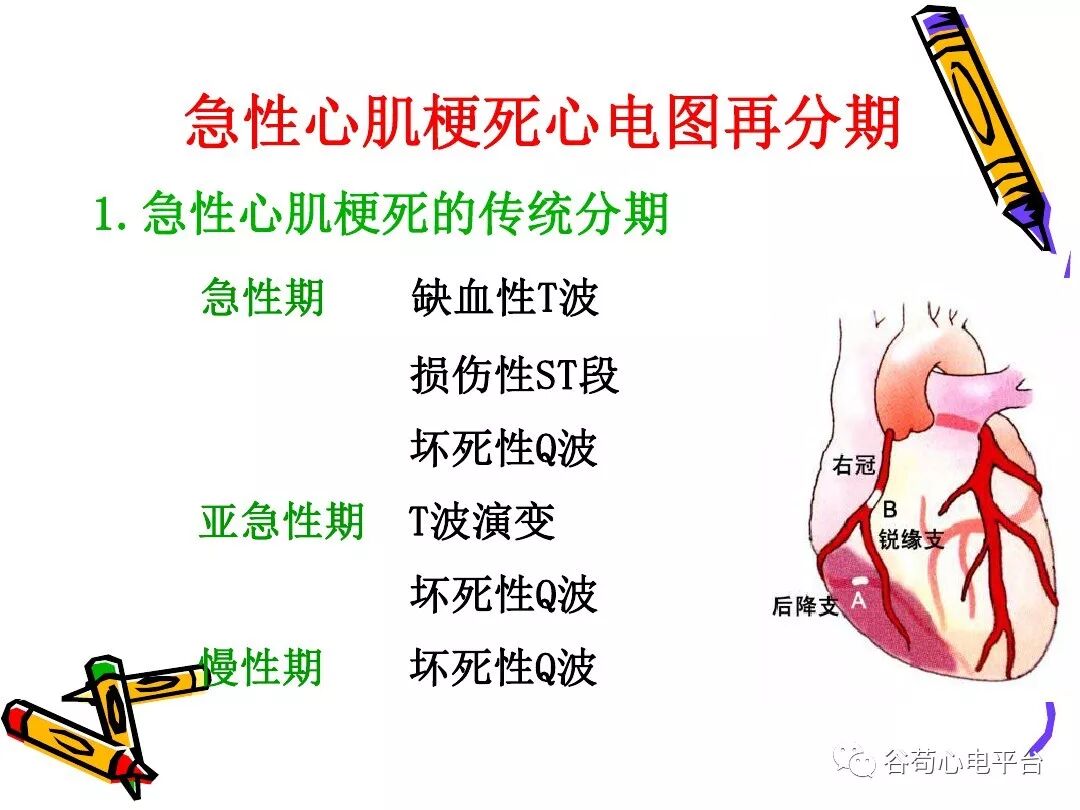 急性心肌梗死新定义（全球统一定义）