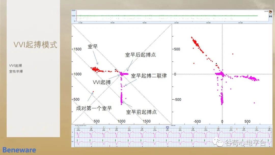 如何阅读24小时动态心电图?