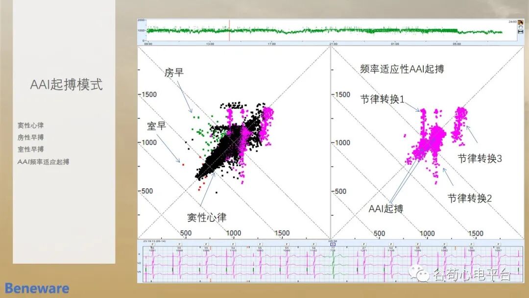如何阅读24小时动态心电图?