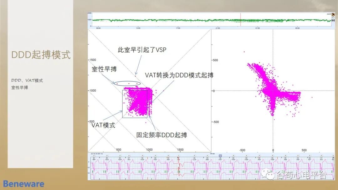 如何阅读24小时动态心电图?