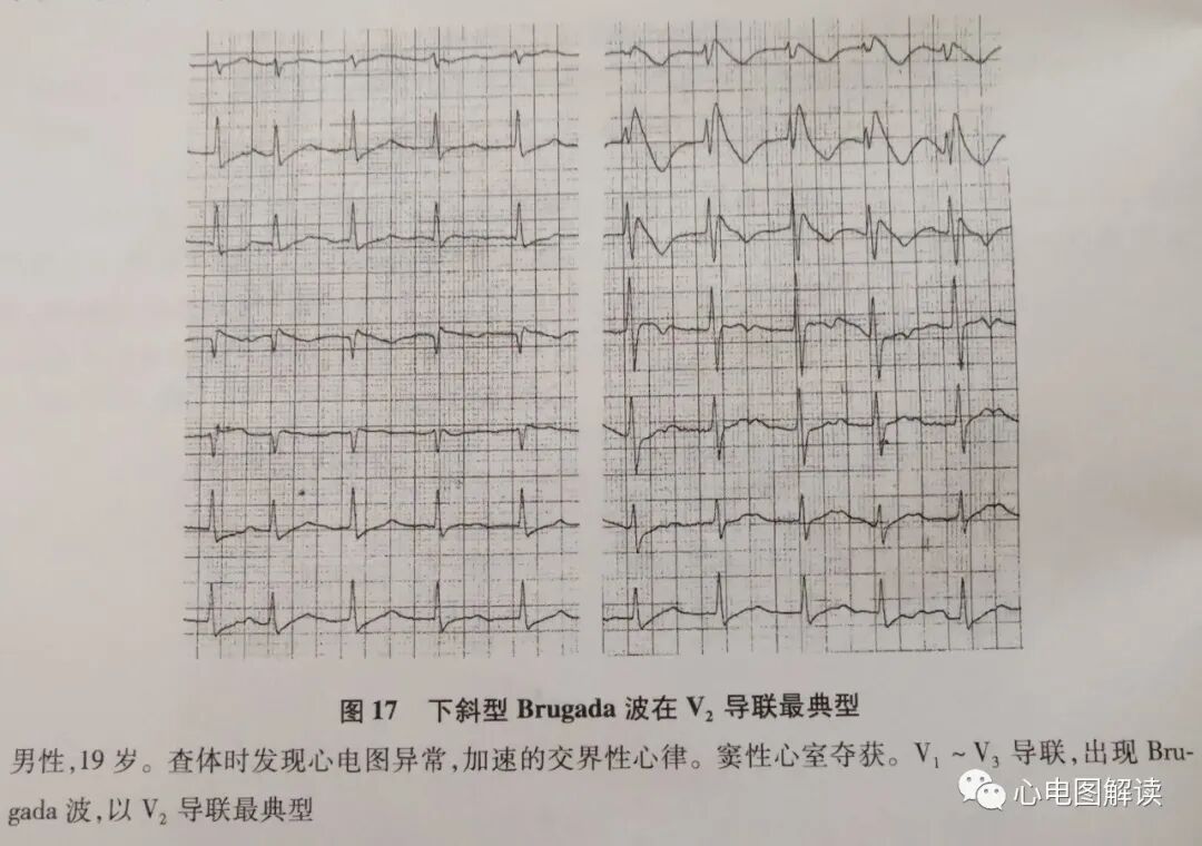 Brugada波与Brugada综合征