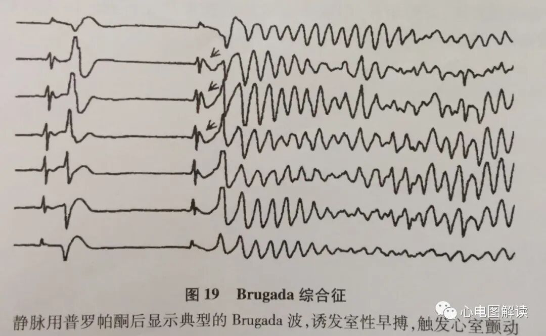 Brugada波与Brugada综合征