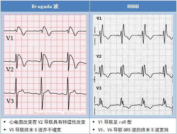 点击查看原图 Brugada波与Brugada综合征