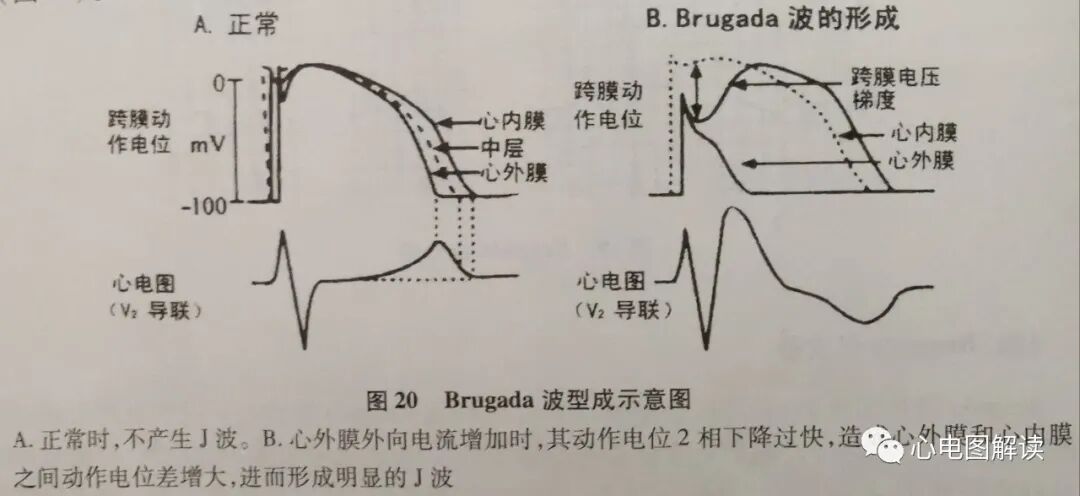 Brugada波与Brugada综合征