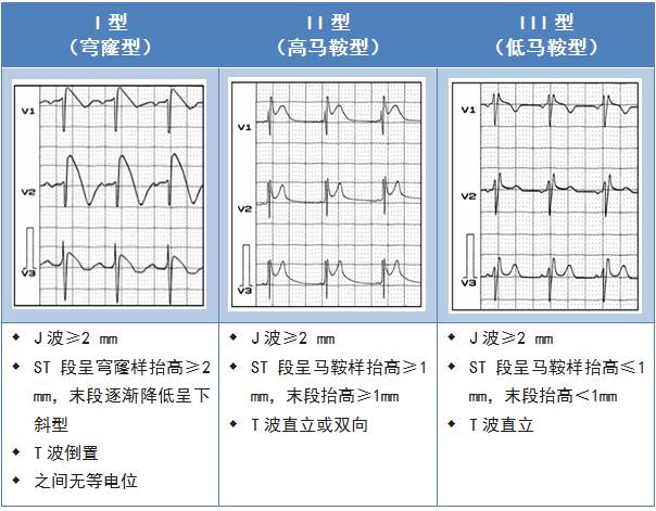 点击查看原图 Brugada波与Brugada综合征