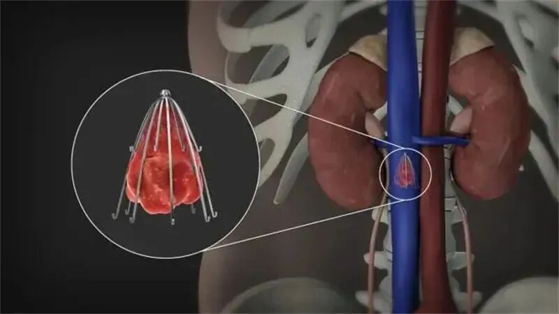 骨折受伤需要手术,下肢出现血栓,什么时候需要放滤器?