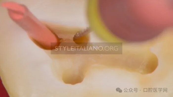 融合根管的处理