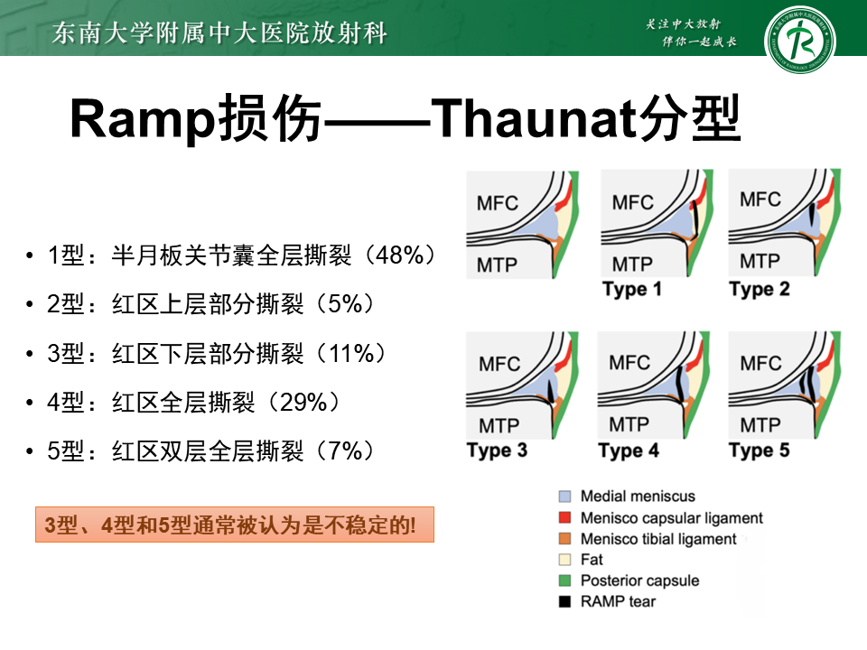 半月板Ramp损伤的解剖与分型