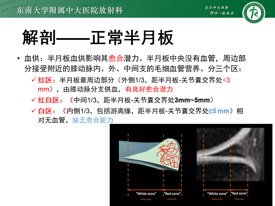 半月板Ramp损伤的解剖与分型