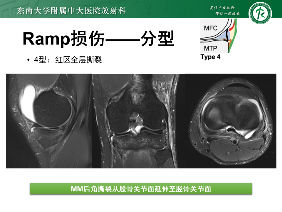 半月板Ramp损伤的解剖与分型