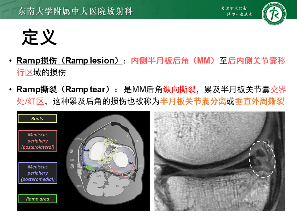半月板Ramp损伤的解剖与分型