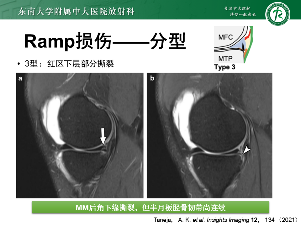半月板Ramp损伤的解剖与分型