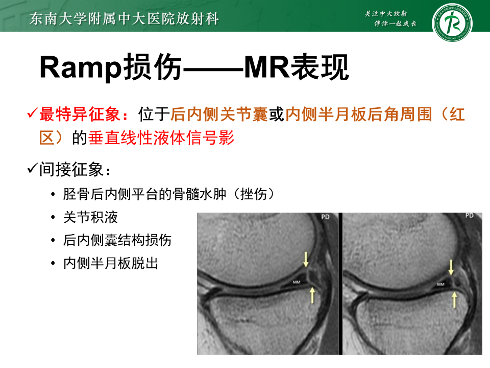 半月板Ramp损伤的解剖与分型