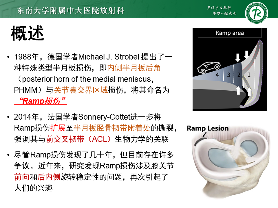 半月板Ramp损伤的解剖与分型