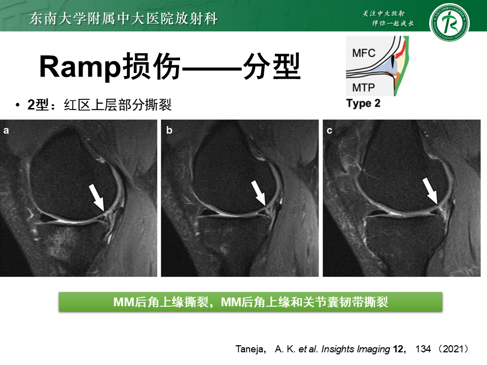 半月板Ramp损伤的解剖与分型