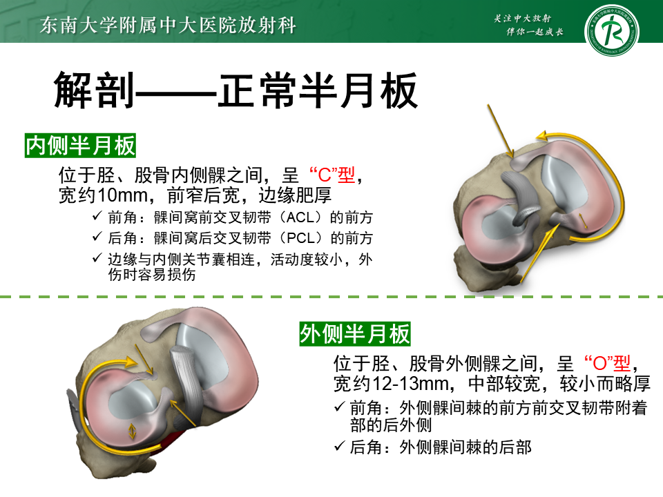 半月板Ramp损伤的解剖与分型