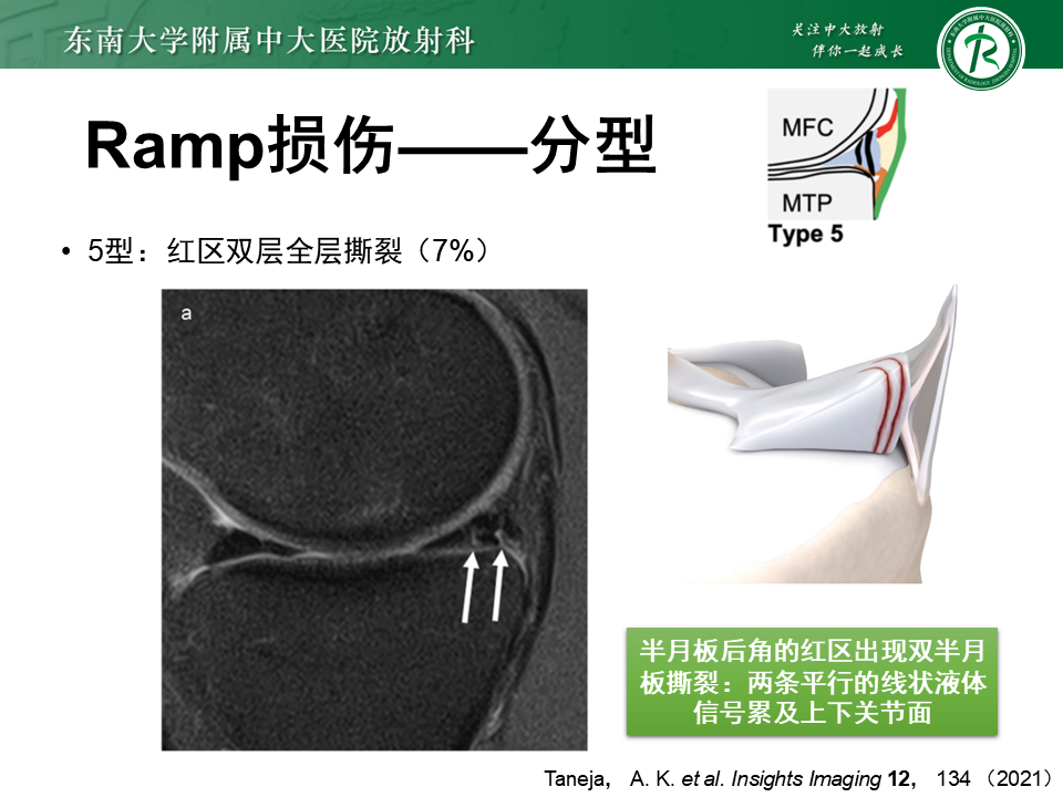 半月板Ramp损伤的解剖与分型