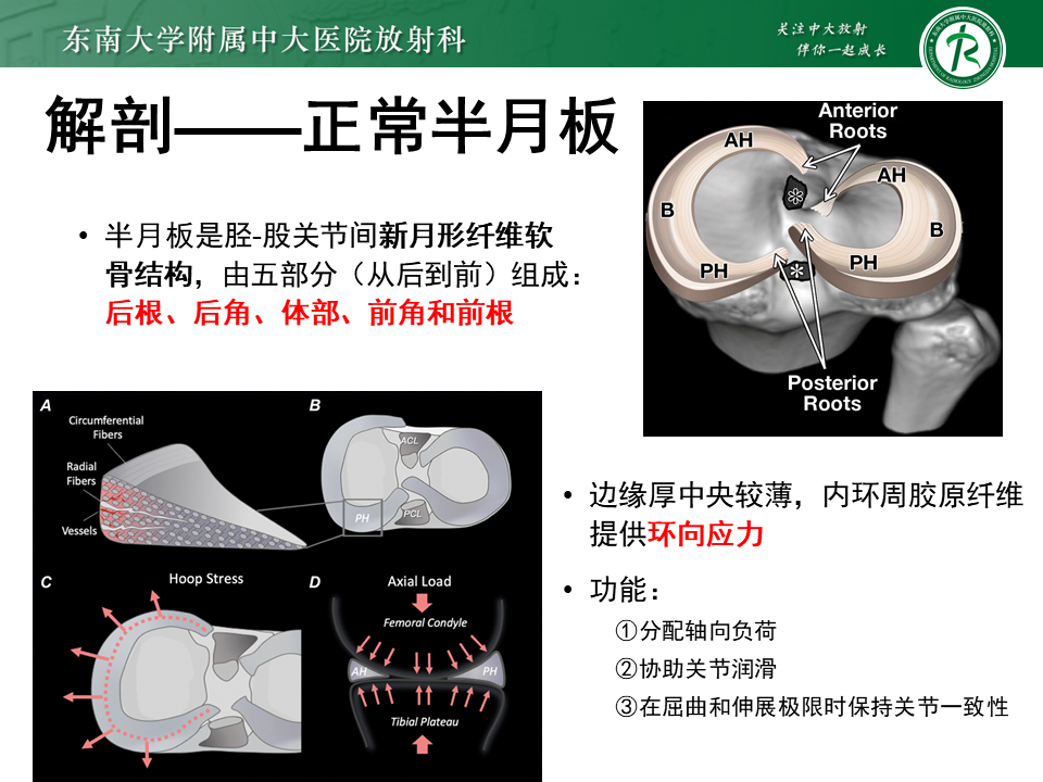 半月板Ramp损伤的解剖与分型