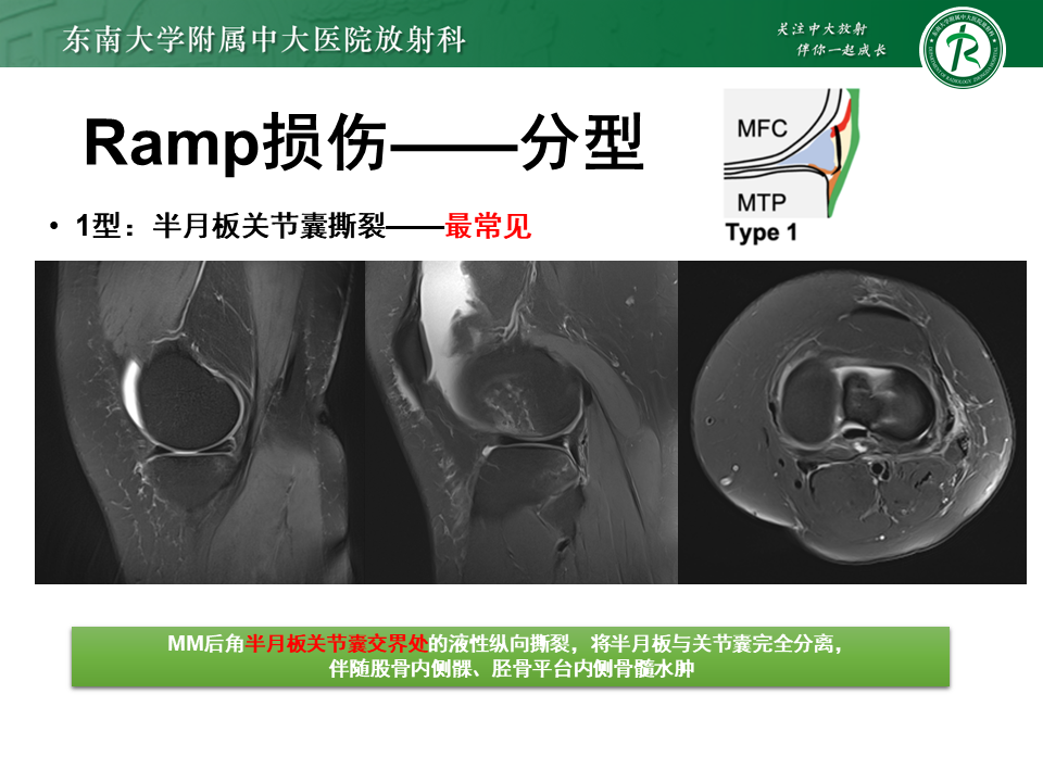 半月板Ramp损伤的解剖与分型