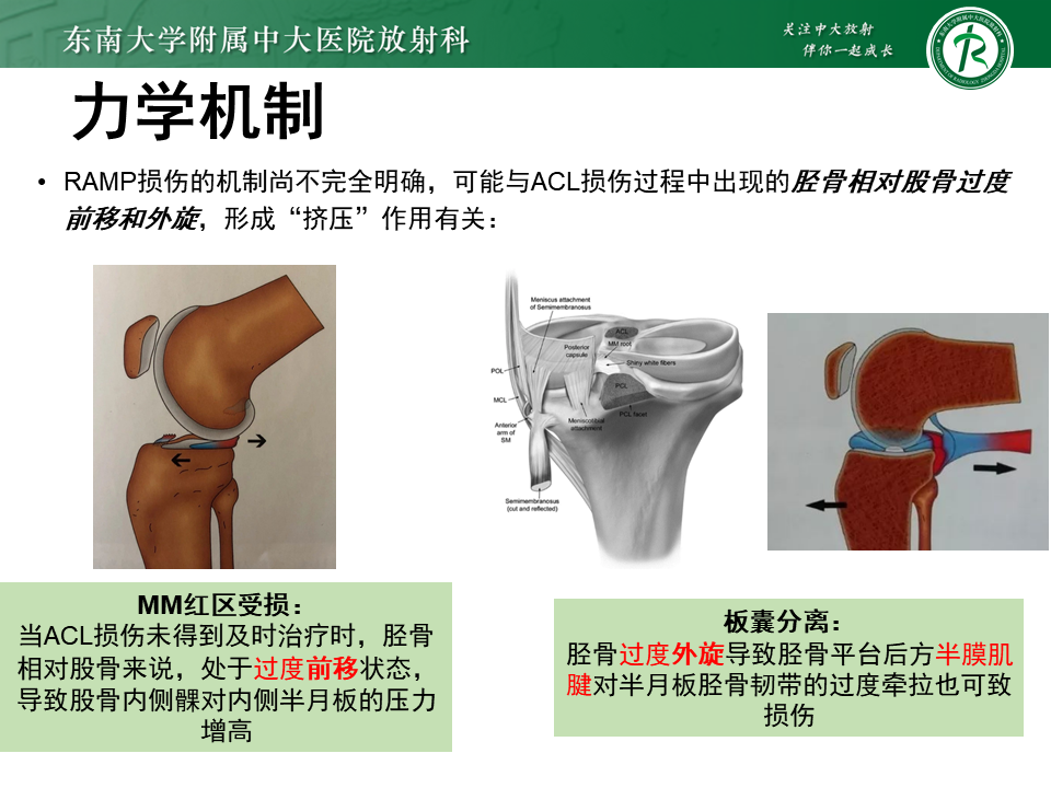 半月板Ramp损伤的解剖与分型