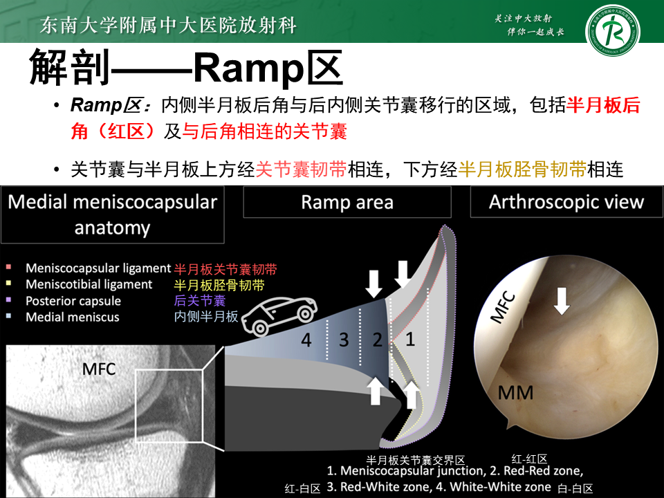 半月板Ramp损伤的解剖与分型