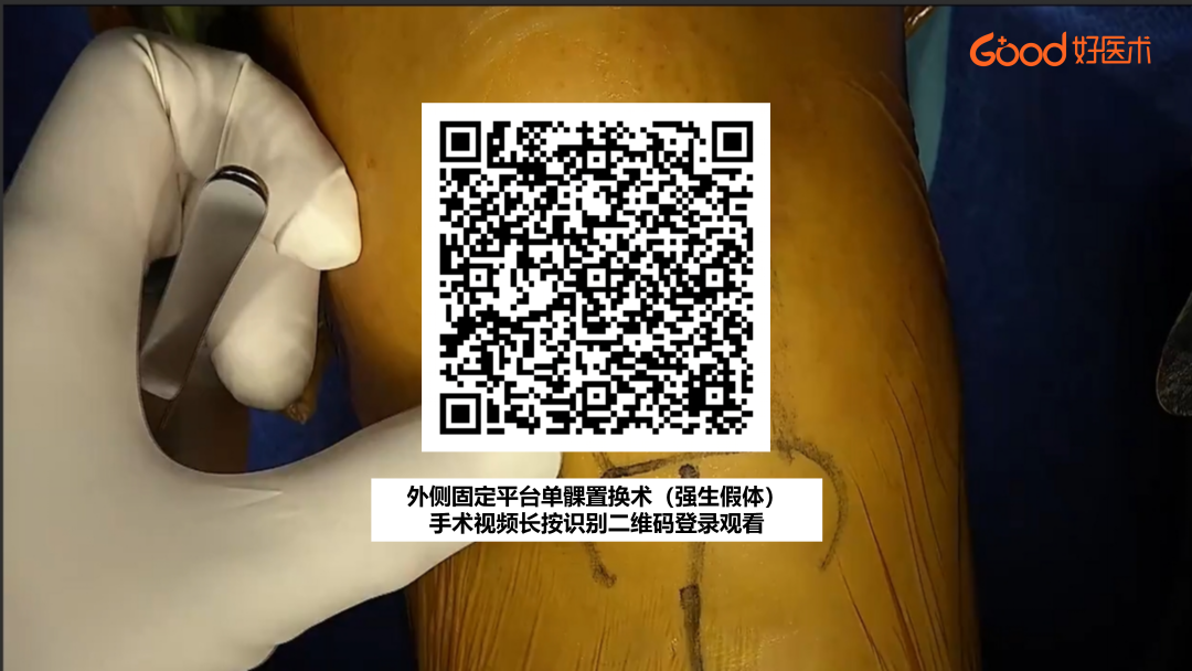 【手术视频】第八期：外侧固定平台单髁置换术（强生假体）