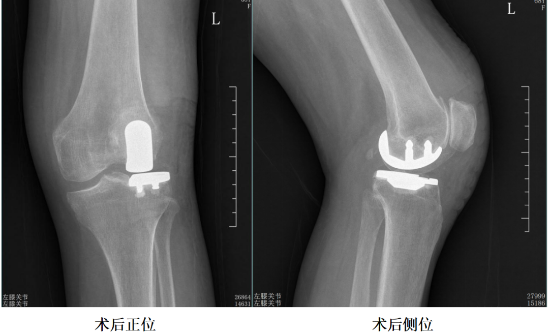【手术视频】第八期：外侧固定平台单髁置换术（强生假体）