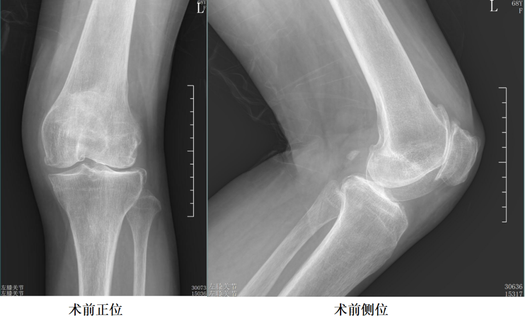 【手术视频】第八期：外侧固定平台单髁置换术（强生假体）