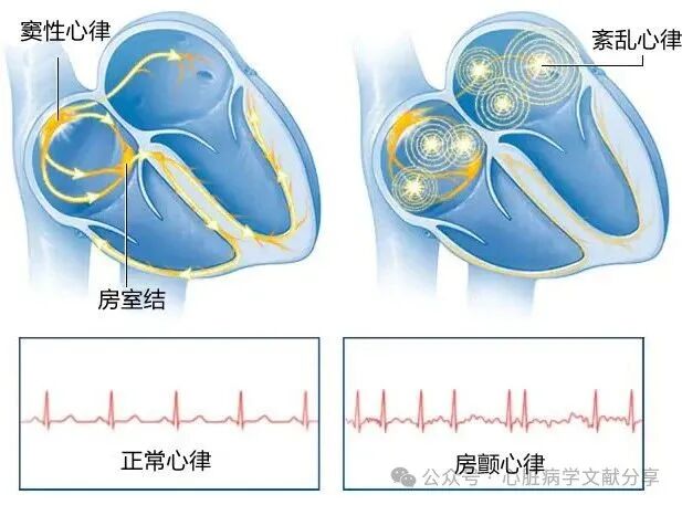房颤导管消融技术概论