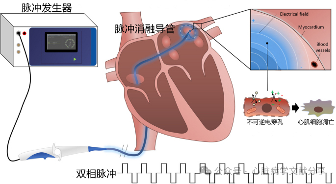 房颤导管消融技术概论