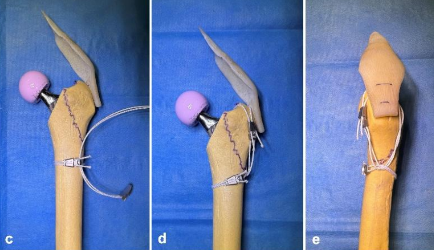 4种捆扎方法，固定THA假体周围大转子骨折