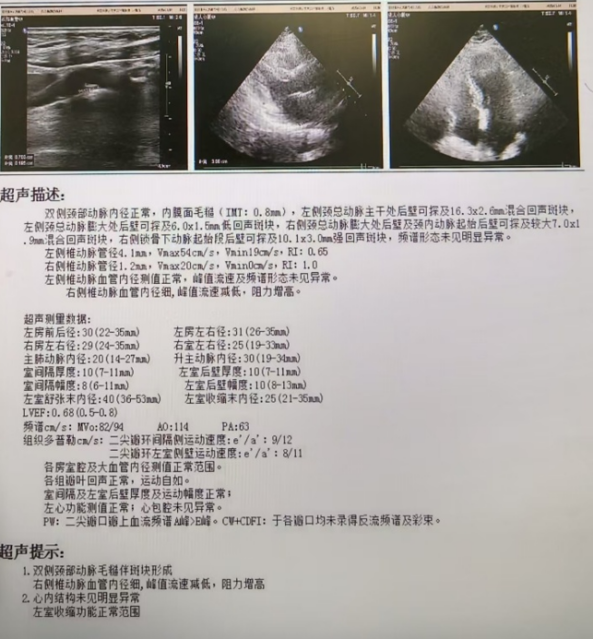 以柔克刚,事半功倍——OCT指导下冲击波球囊处理严重冠脉钙化病变