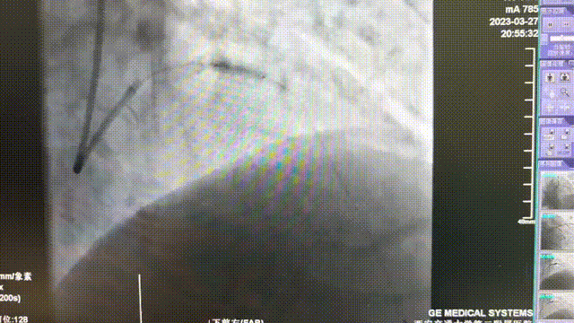 以柔克刚,事半功倍——OCT指导下冲击波球囊处理严重冠脉钙化病变